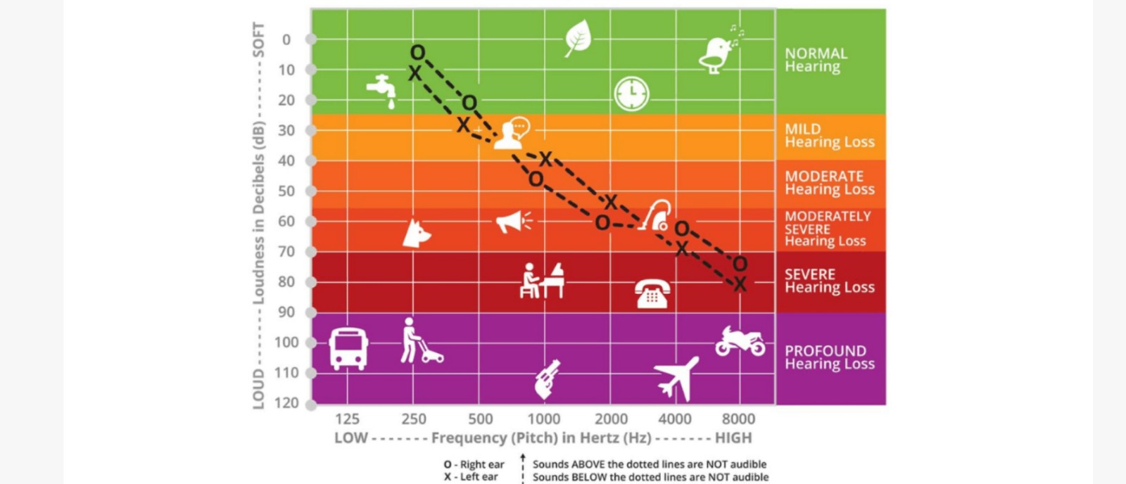 Moderate Hearing Loss: Get tested and explore solutions for better hearing | Aanvii Hearin
